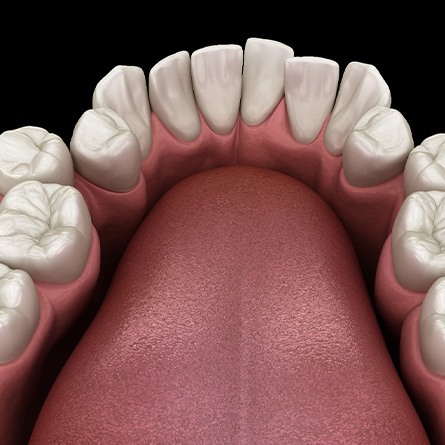Illustration of crowded teeth