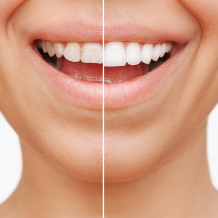 Before and after cosmetic dentistry