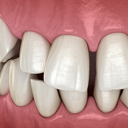 Illustration of gapped teeth