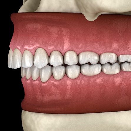 Illustration of an overbite