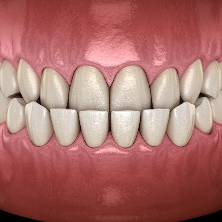 Illustration of an underbite