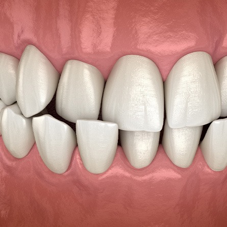 Illustration of a crossbite