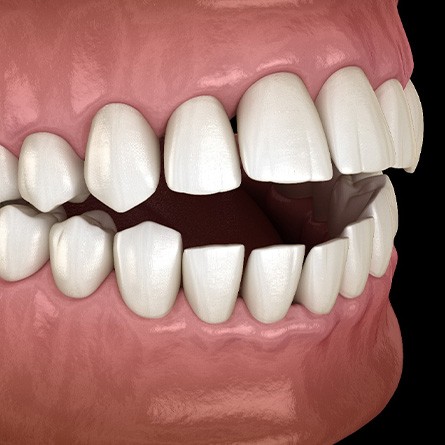 Illustration of an open bite