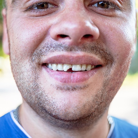 smiling man with a chipped tooth