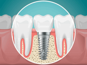 Digital image of a dental implant next to two natural teeth