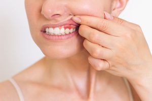 Nose-to-shoulder view of woman pulling back upper lip to reveal darkened gums